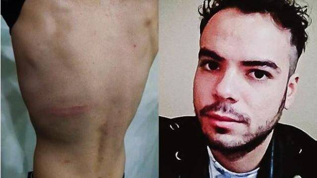Thiago Britto foi agredido em várias partes do corpo: o agressor quebrou uma vassoura nas suas costas. As fotos foram feitas pela própria vítima.