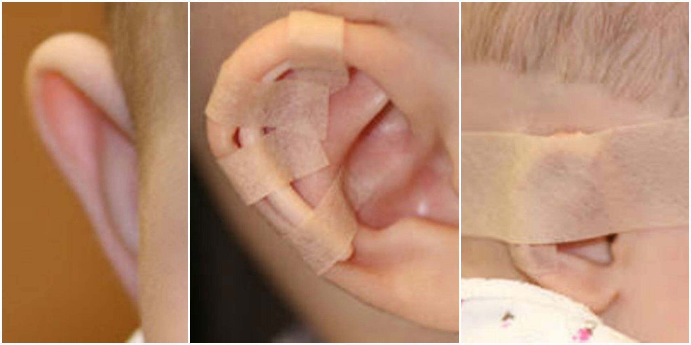 O splint deve ser colocado na orelha do bebê  no máximo 48 horas depois do nascimento / Foto: divulgação