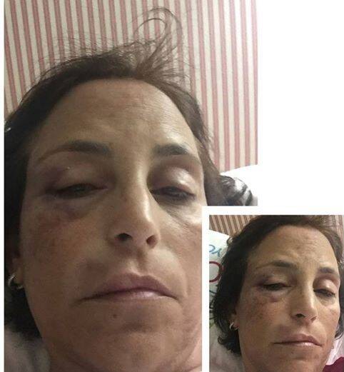 Renata Cordeiro Guerra: a imagem mostra como ficou o rosto da advogada, depois da agressão em Ipanema / Foto: reprodução Facebook 